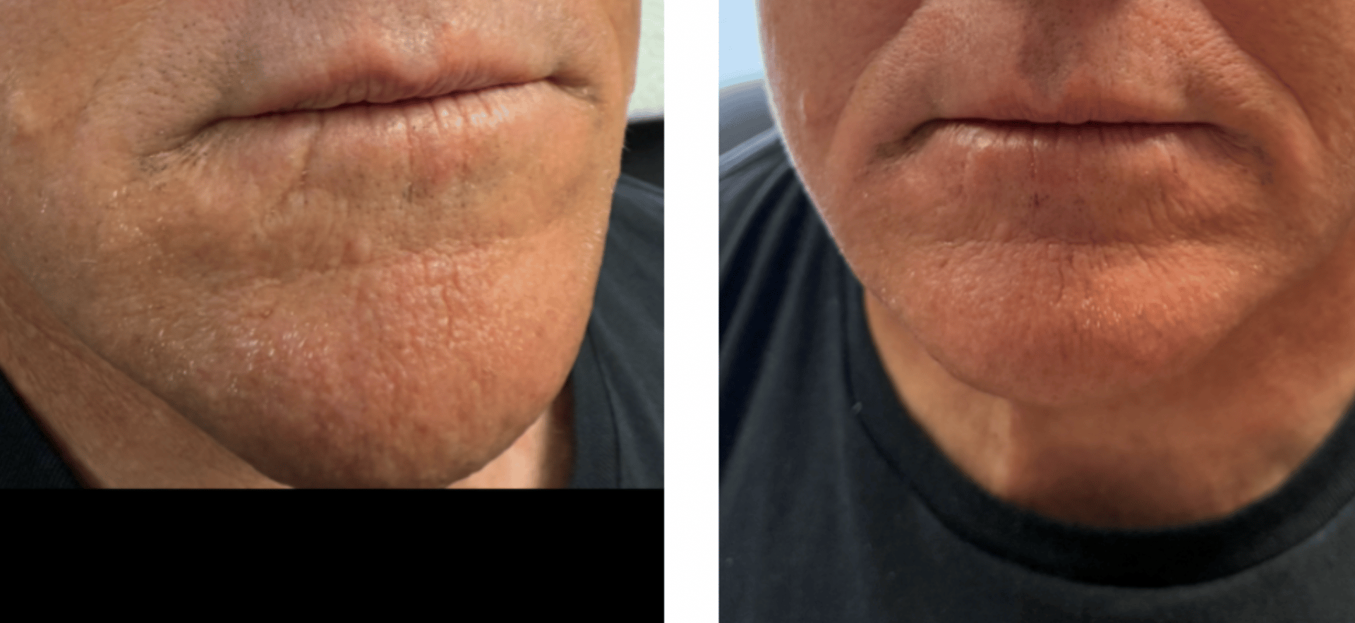 Before and After Scar Revision Treatment showing dramatic improvement in scar appearance
