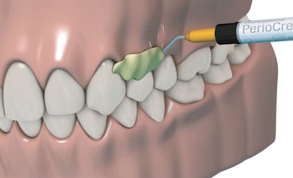 bonyf PerioCream Benefits