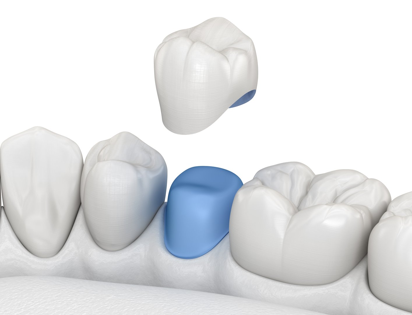 Porcelain crown placement over premolar tooth. 3D illustration