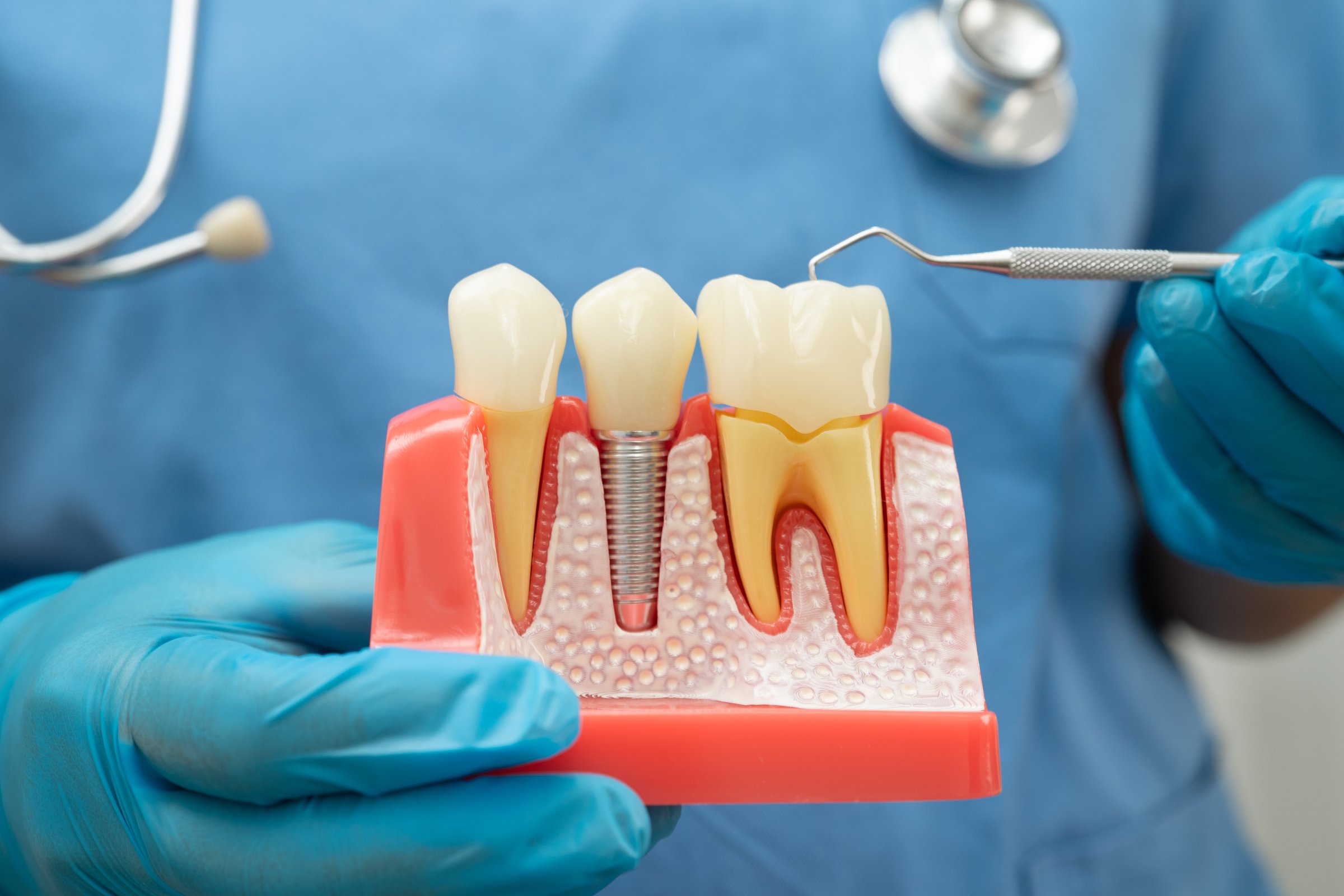 Dentist holding dental implant, artificial tooth roots into jaw, root canal of dental treatment, gum disease, teeth model for dentist.