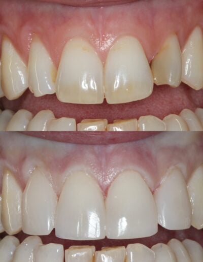 Patient smile with dental crowns - cosmetic dentistry results