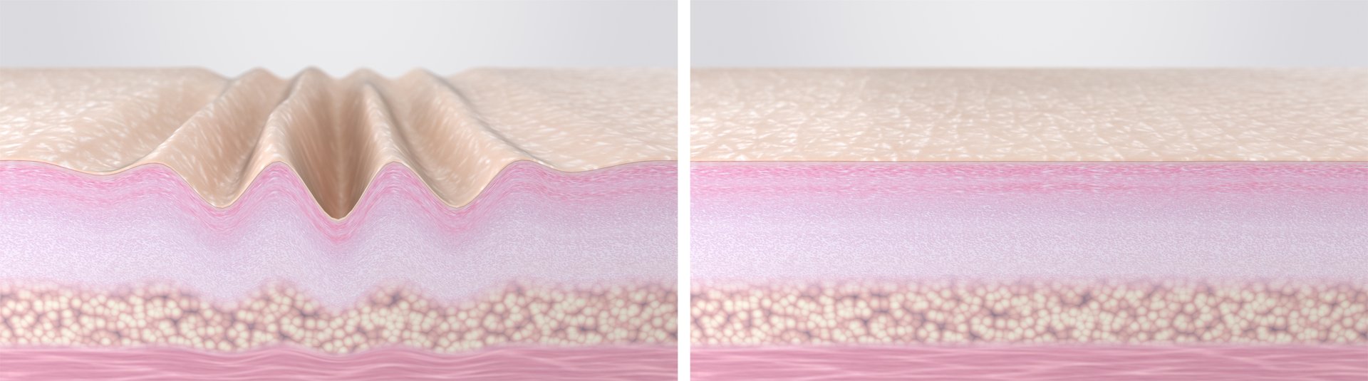 3d rendered illustration. Cross-section of skin tissues before and after hyaluronic acid injections, collagen peptides, laser therapy, EMS, RF facelift