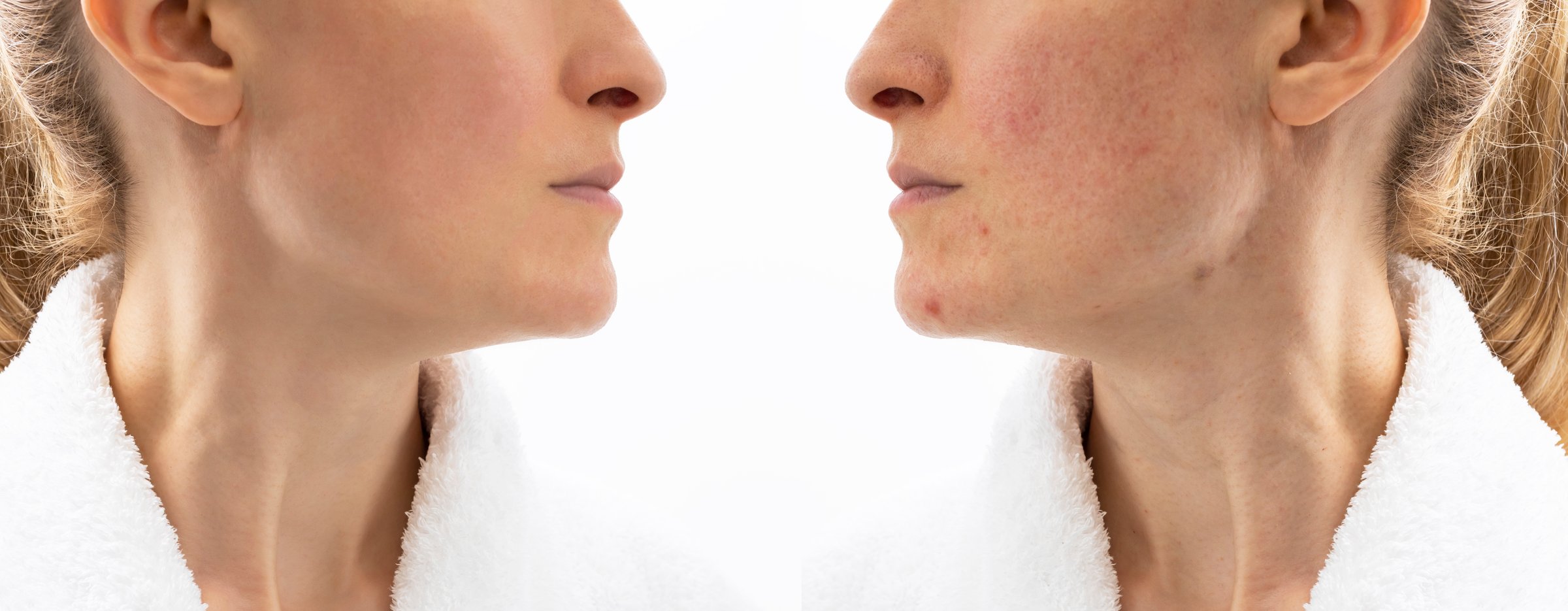 Before and After Skin Acne Treatment face of woman with Acne Problem