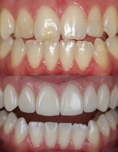 Patient smile transformation - before and after dental treatment