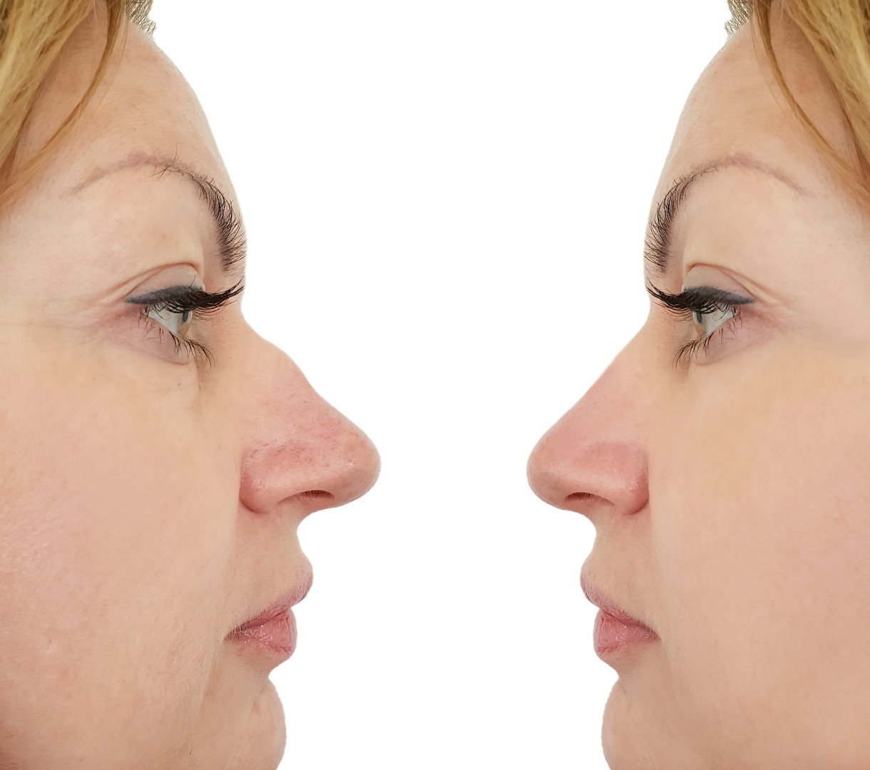 female nose hump correction before and after procedures