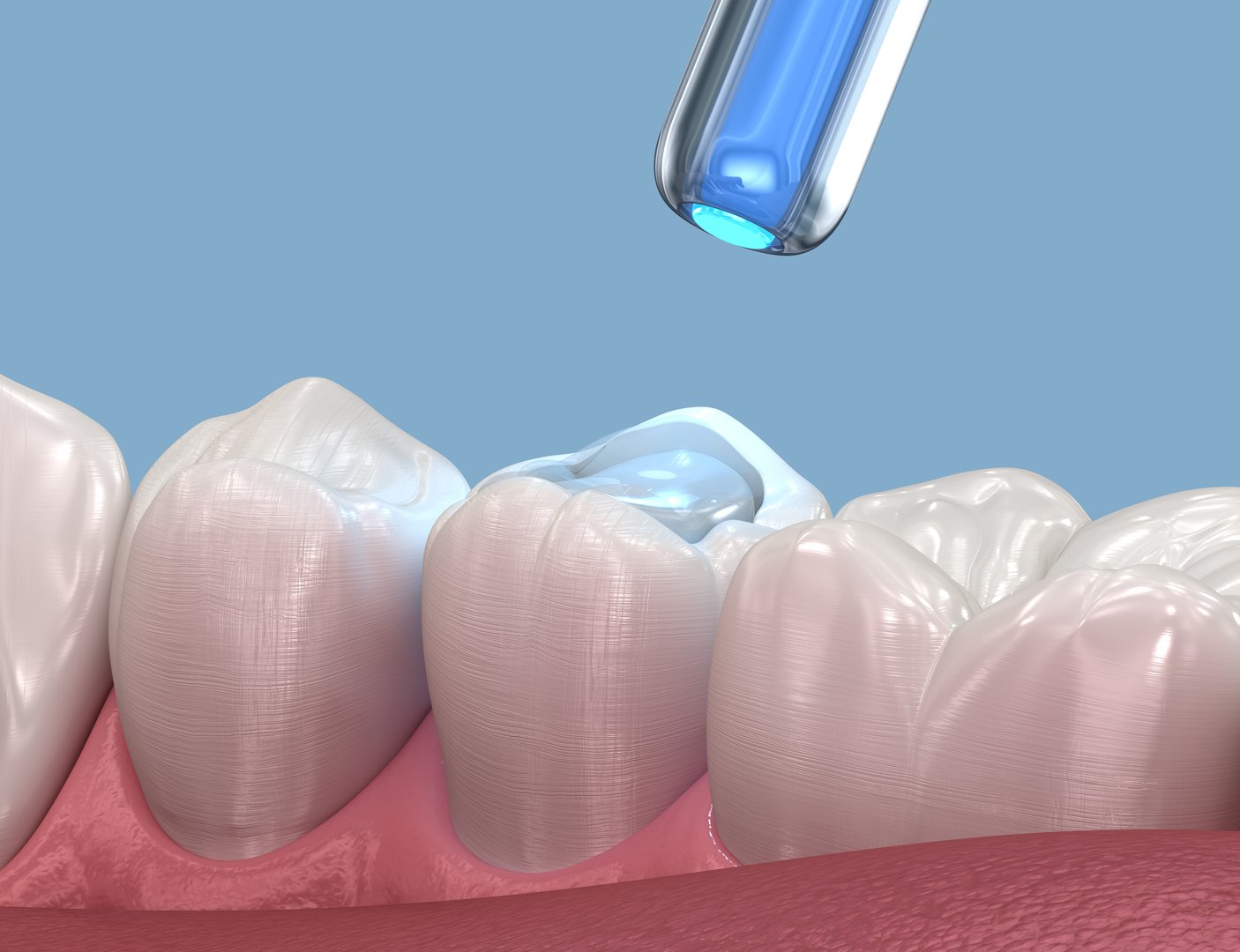 Dental composite bonding