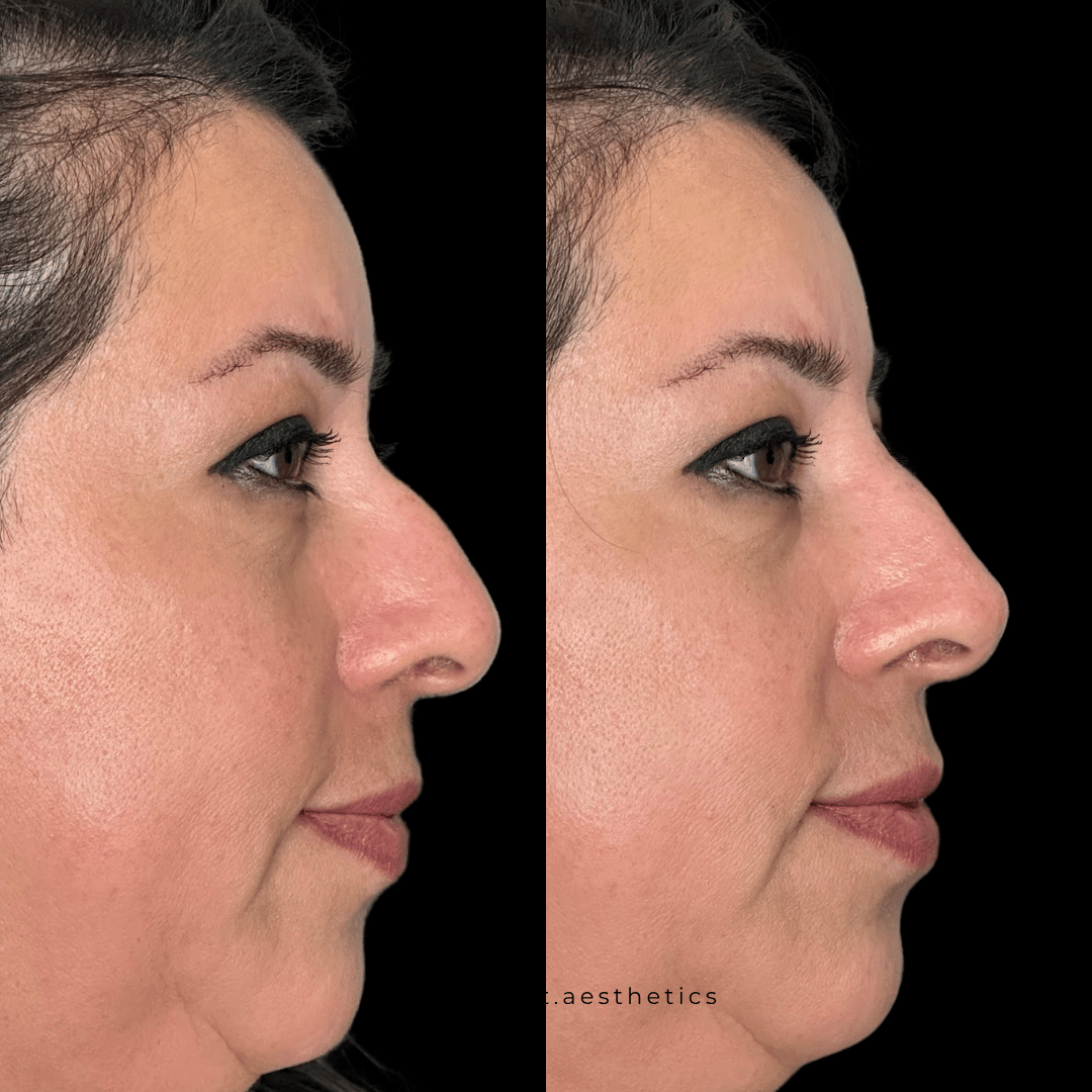 Nasal tip refinement