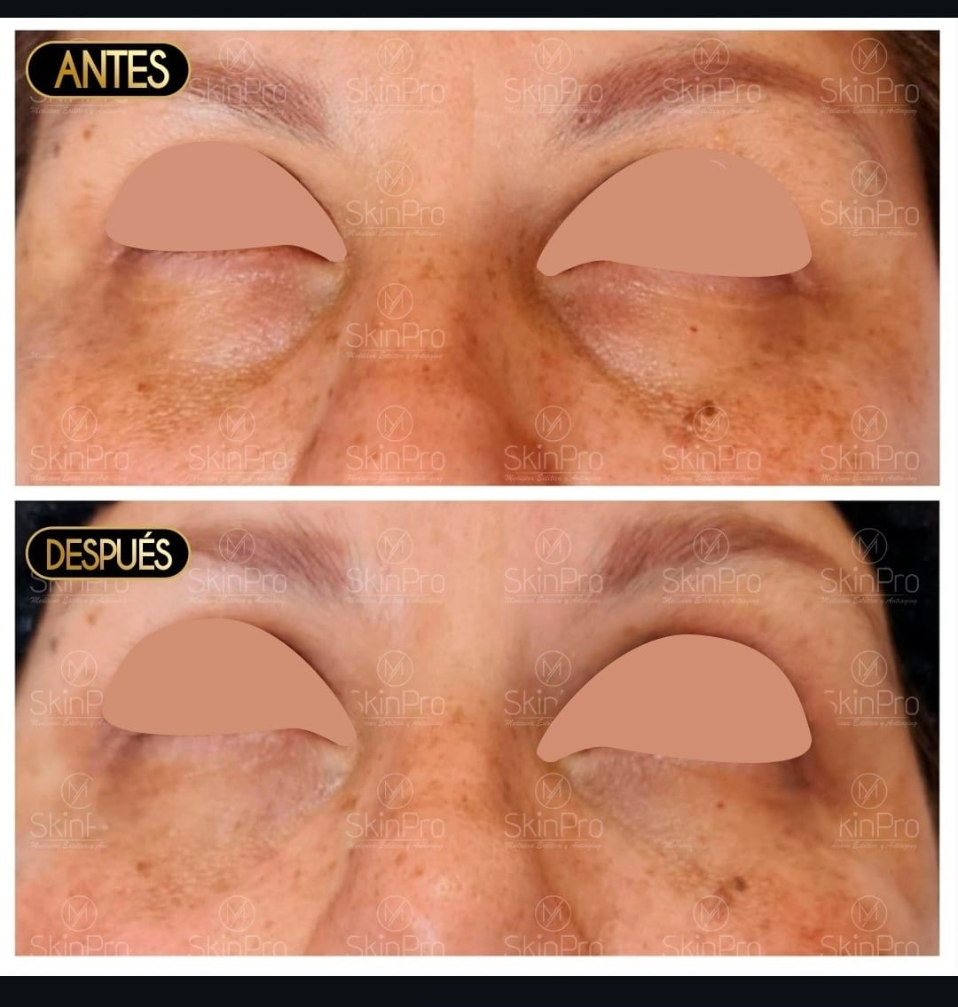 Resultado del tratamiento