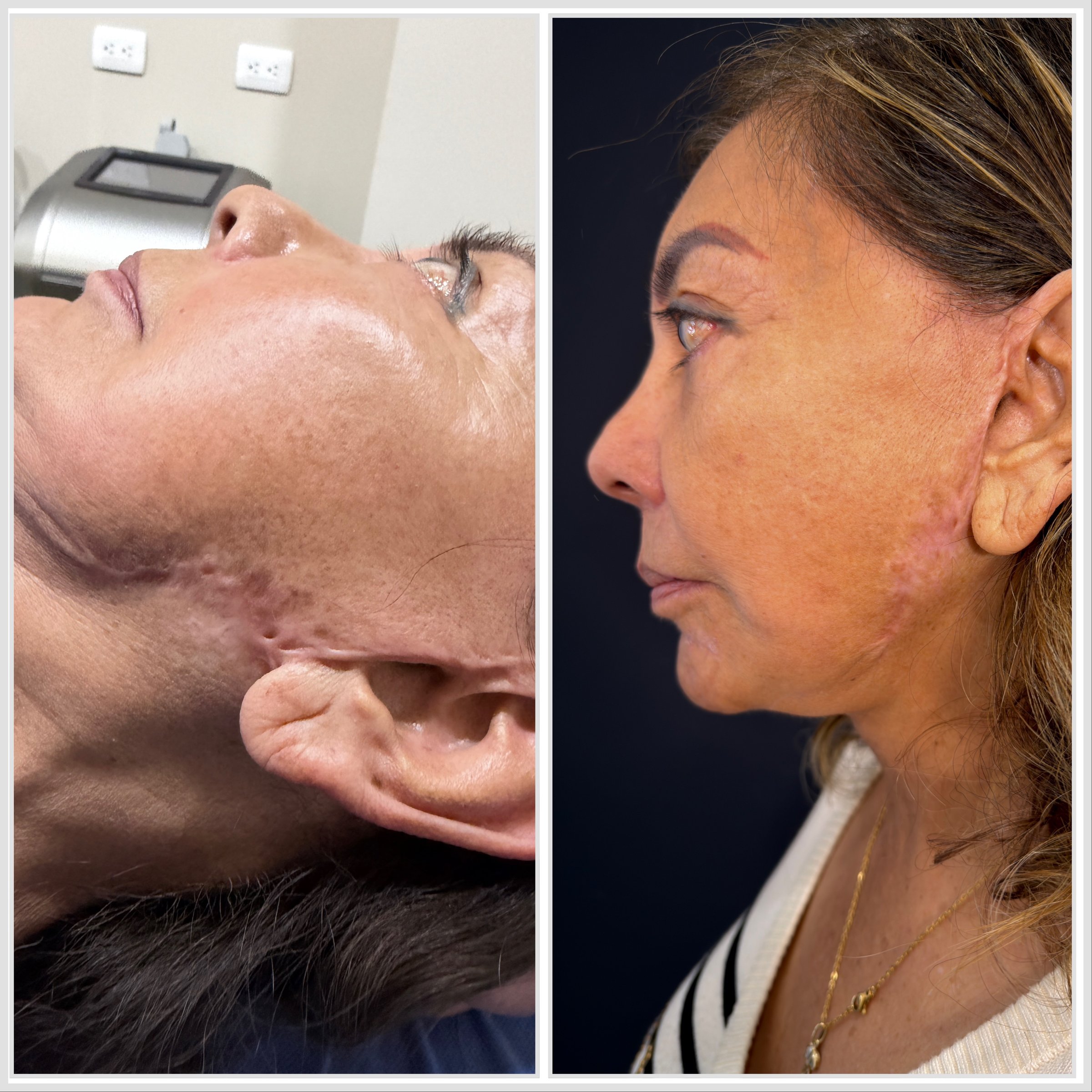 Antes y después - Eliminar Cicatrices