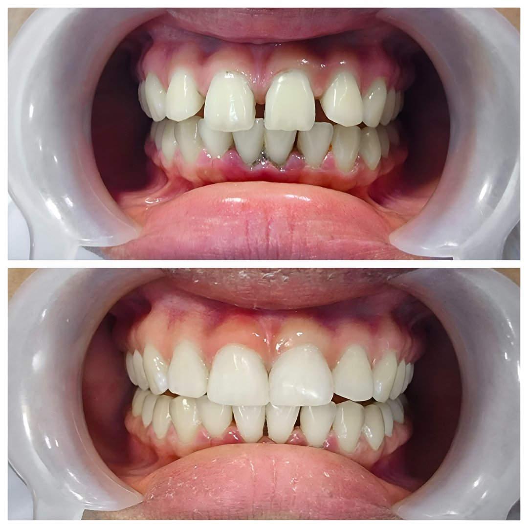 Before and After Fixing Large Gap Between Front Teeth