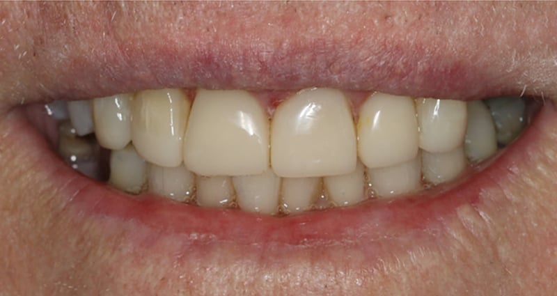 After veneers treatment