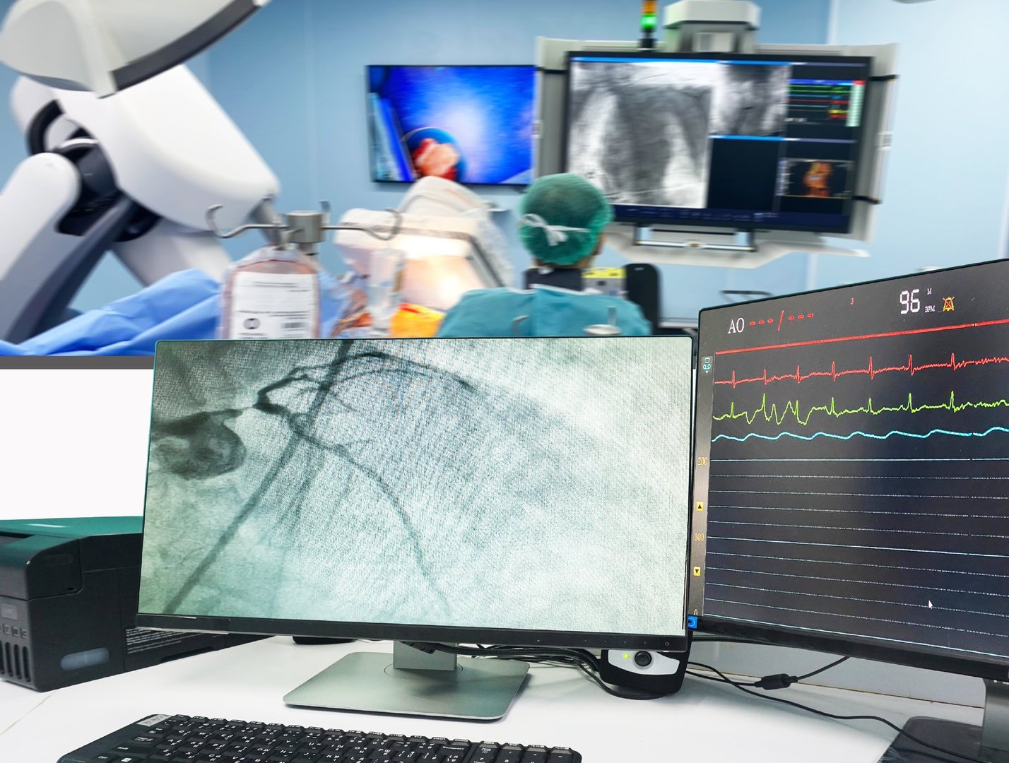 Coronary angiogram (CAG) on LCD monitor and Blurred of modern Cath Lab with the doctor, nurse, and patient in the operating room background