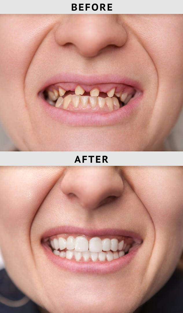 female smile after and before dental crown installation process