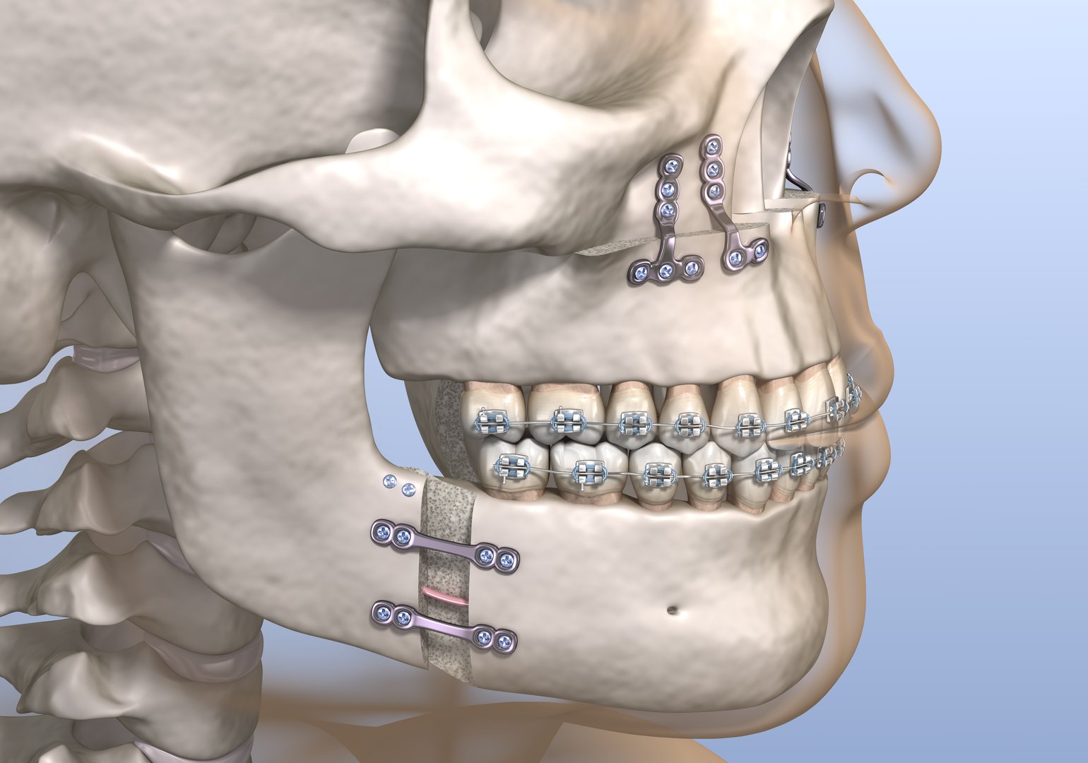 Orthognathic surgery jaw correction