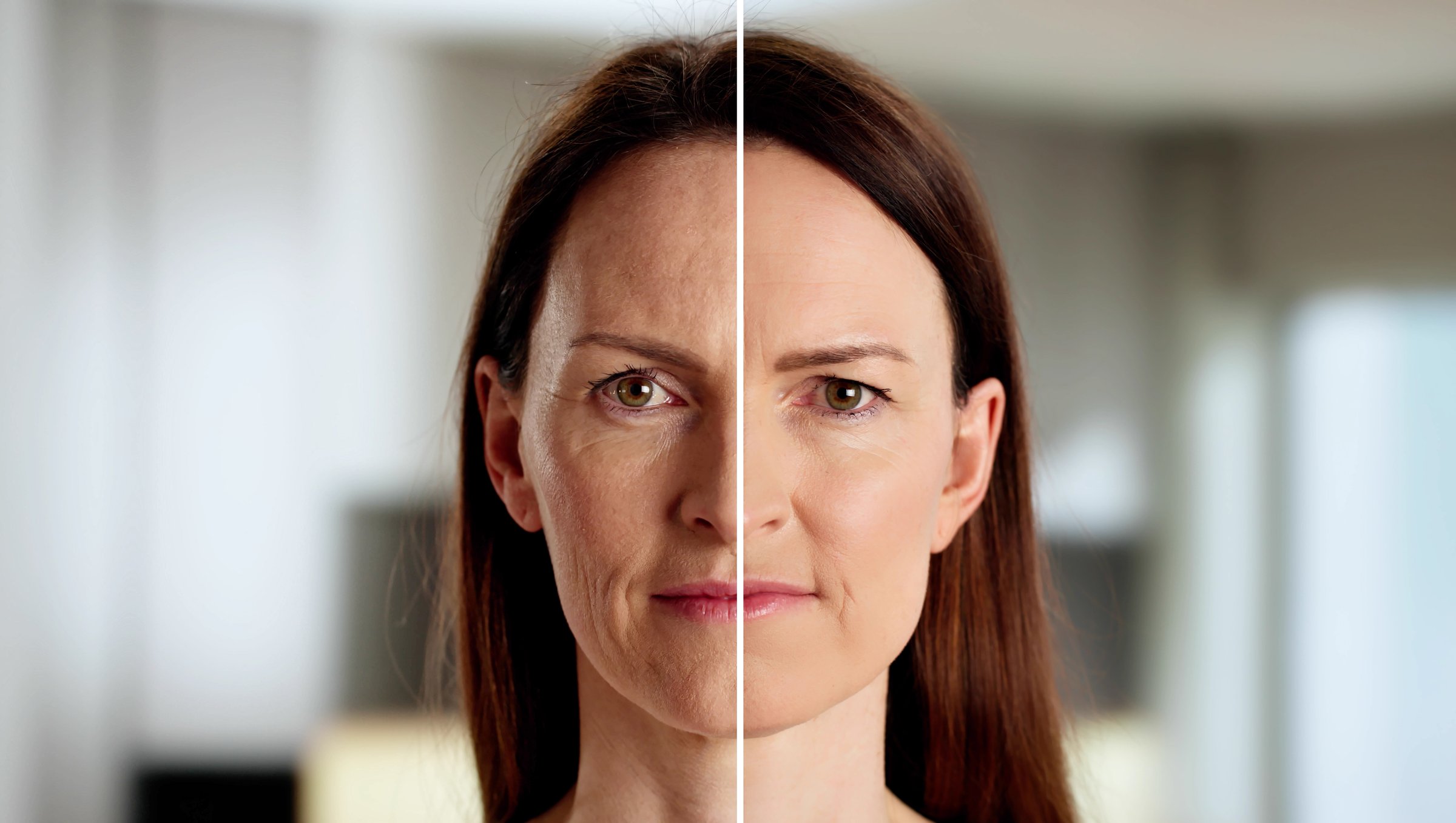 The Transformation Of A Young Woman's Skin: Before And After A Laser Facial Treatment For Wrinkles.