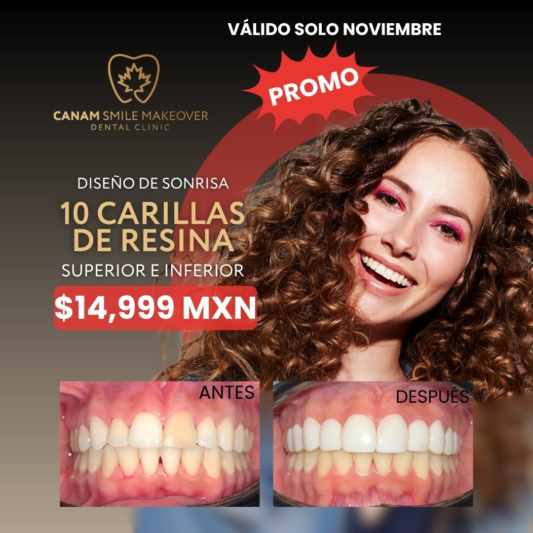 Promoción de Carillas Dentales en Canam Smile Makeover
