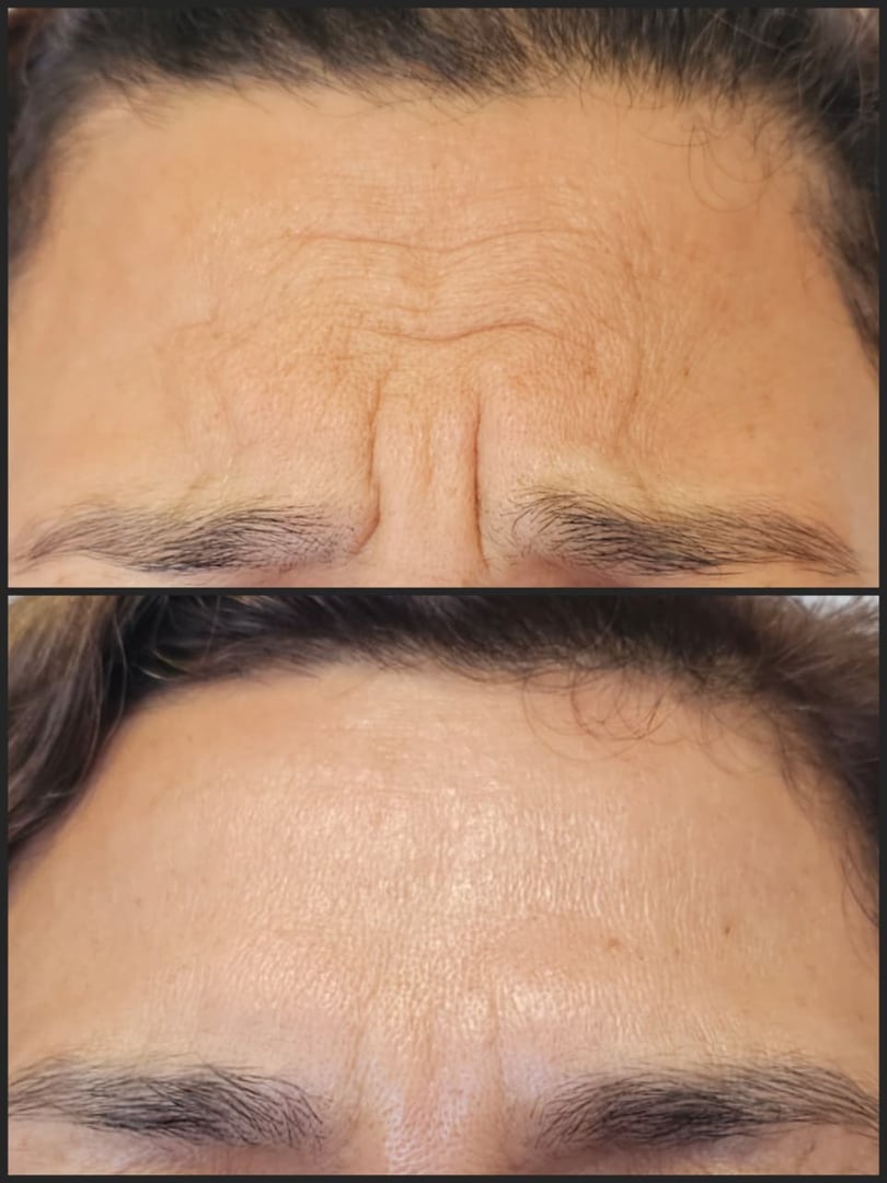 Resultado del tratamiento