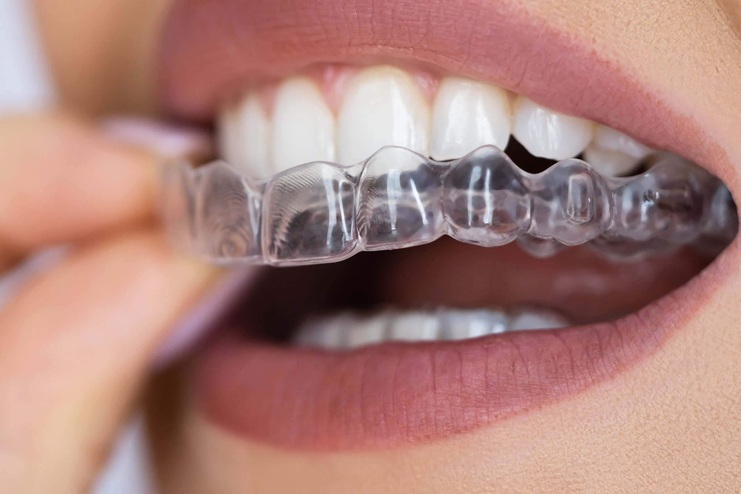 Clear aligner dental night guard for teeth protection