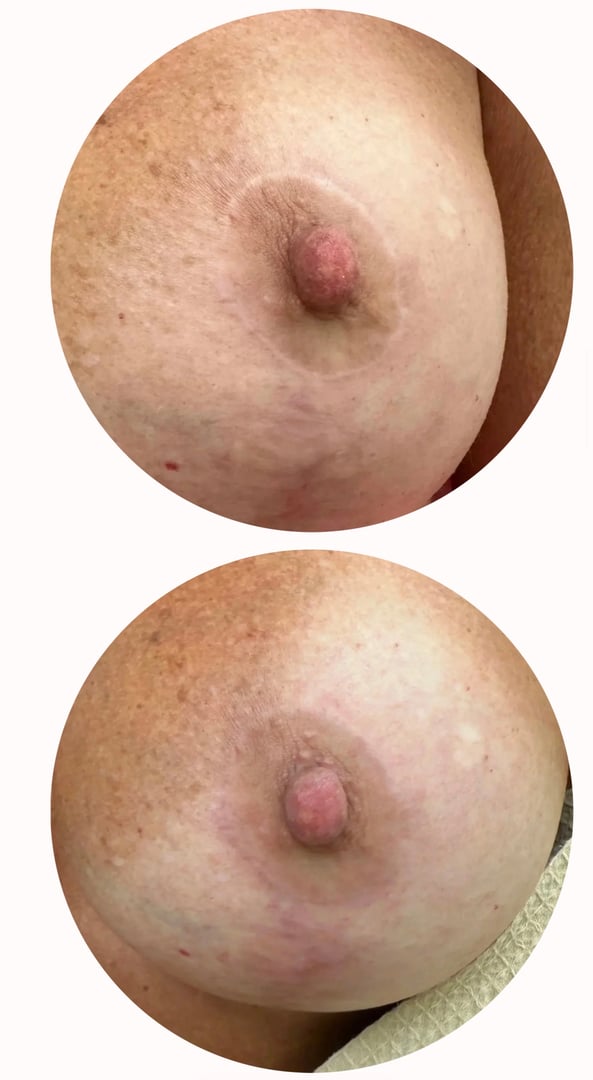 Before and after breast restoration scar camouflage result
