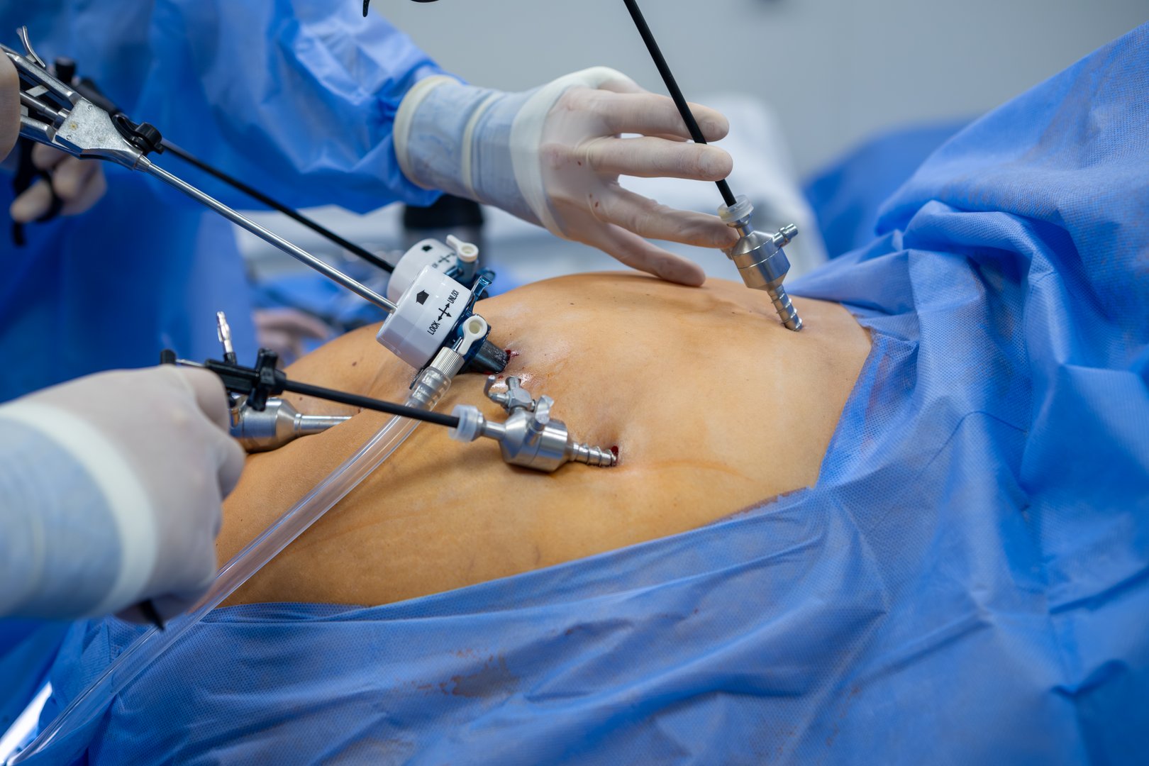 Laparoscopic surgery. Close-up of the doctor's hand using a special medical instrument during the operation.