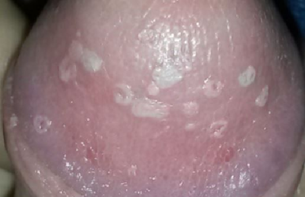 Viêm bao quy đầu bị lở loét