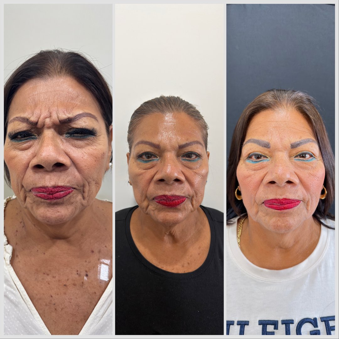 Antes y después - Bioestimuladores