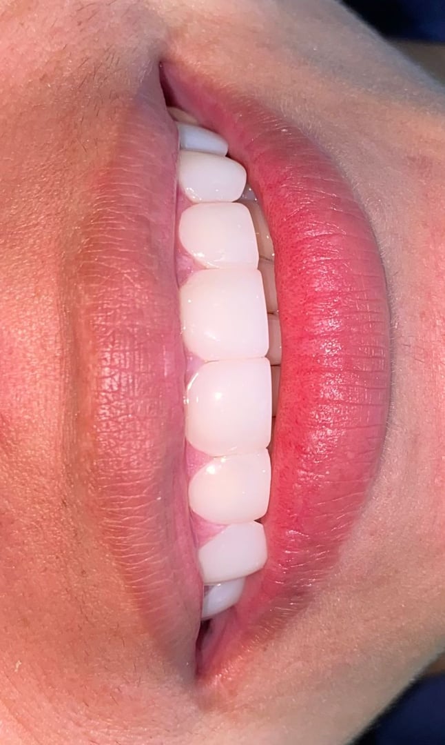 Después del tratamiento - Carillas de resina