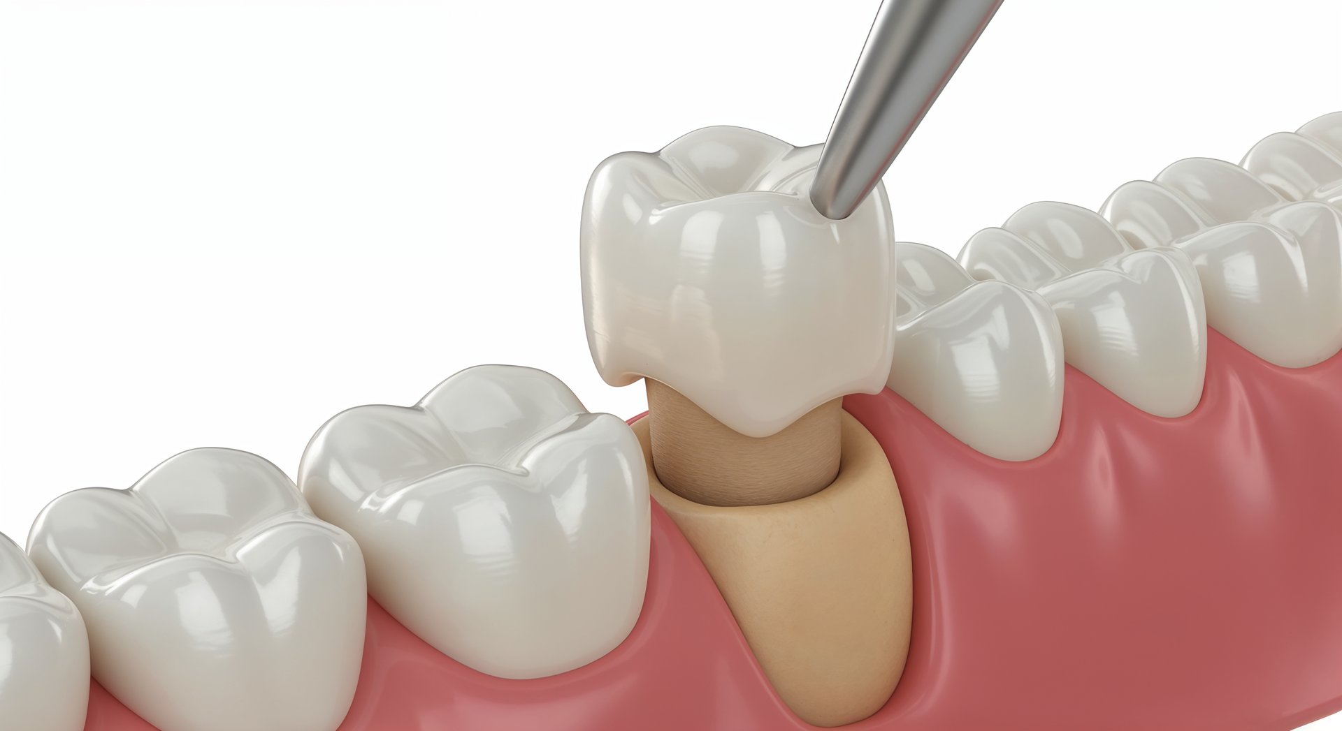 3D dental render,zirconium crown,tooth restoration,dental crown placement,dental prosthetics,cosmetic dentistry,photorealistic dental image,dental crown close-up,zirconia tooth crown,dentistry concept,tooth anatomy,medical 3D illustration,realistic tooth model,dental procedure,oral health,prosthodontics,zirconium dental work,white background,clinical dental image,dental technology,dental care illustration,dental implant visual,dental crown fitting,stomatology image,tooth stump