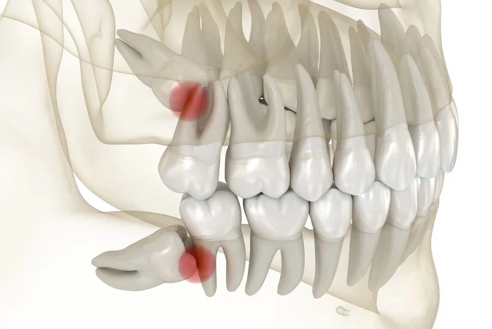 3D dental X-ray model showing impacted wisdom teeth requiring professional oral surgery extraction - mesial and angular impaction positions needing advanced surgical techniques at Murwillumbah Dental for safe tooth removal