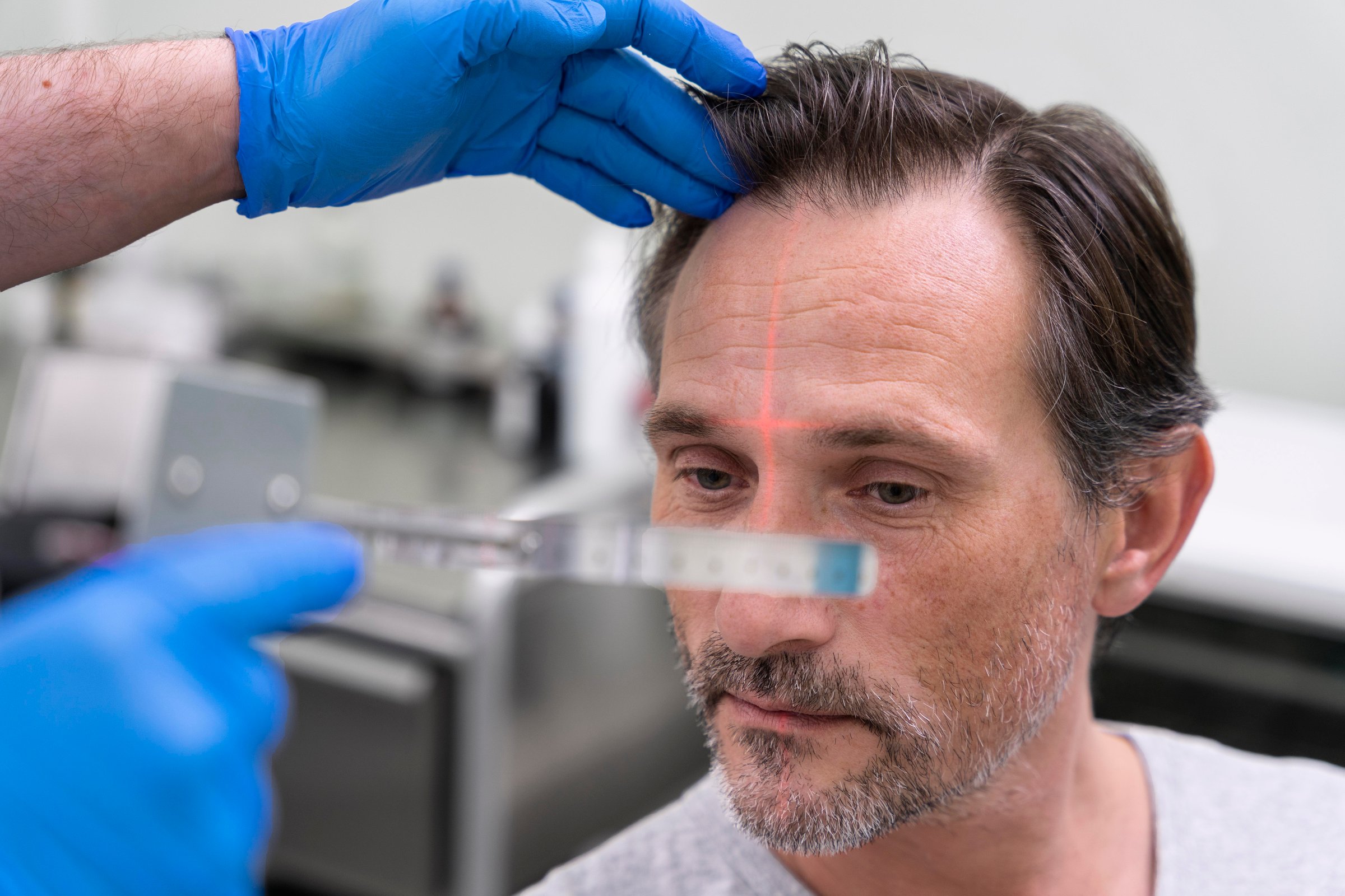 Hair Transplantation