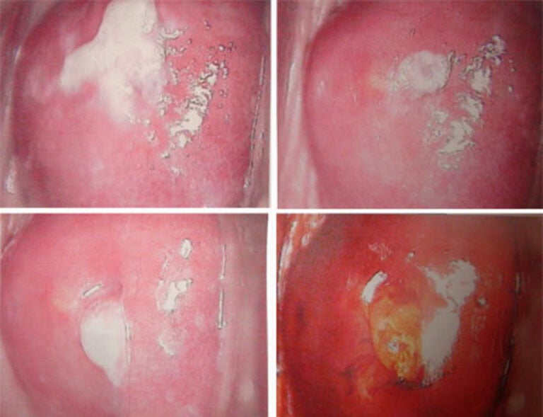 Hình ảnh minh họa biến chứng bệnh lậu