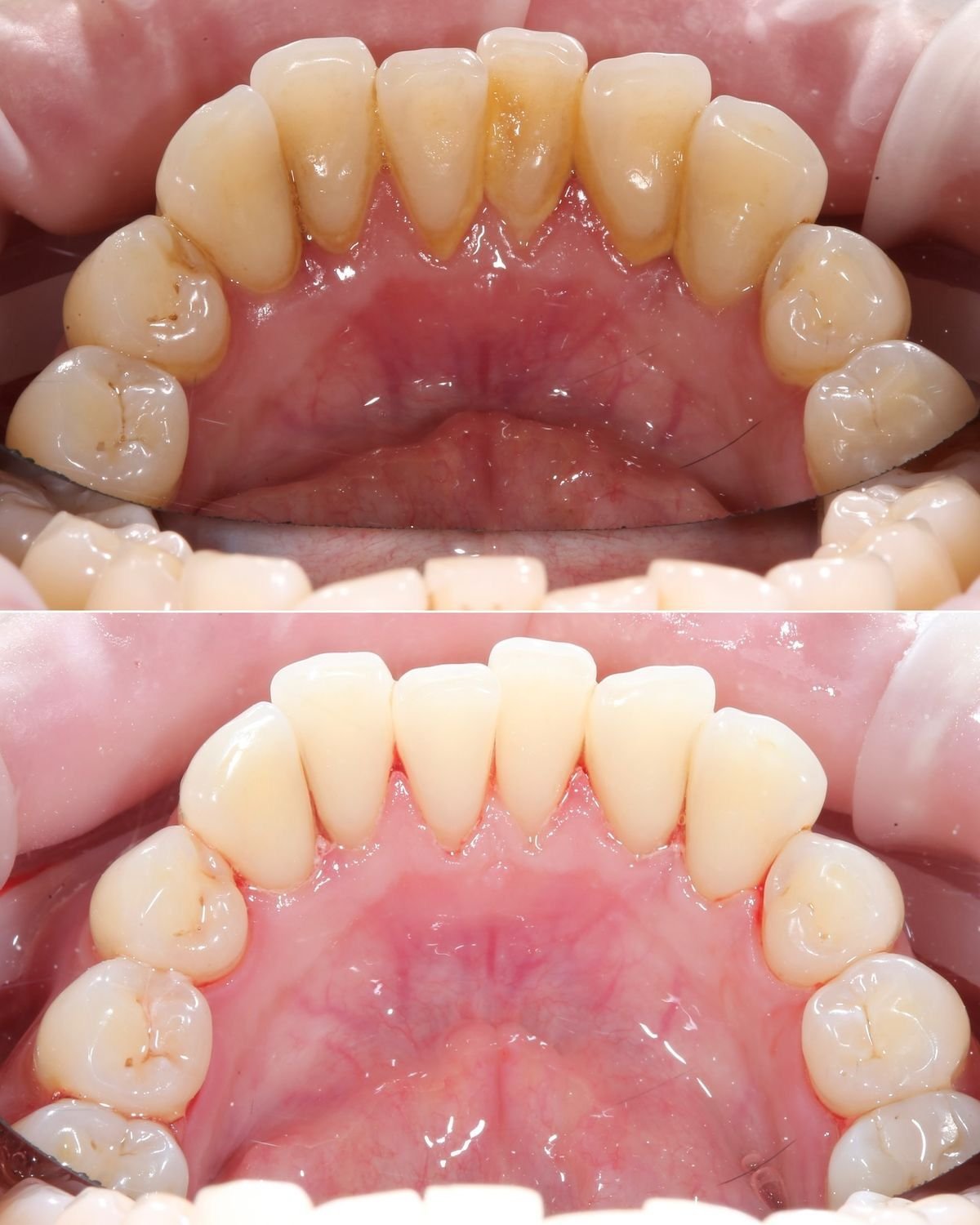 Limpieza dental profesional