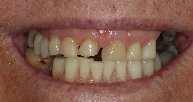 Before veneers treatment