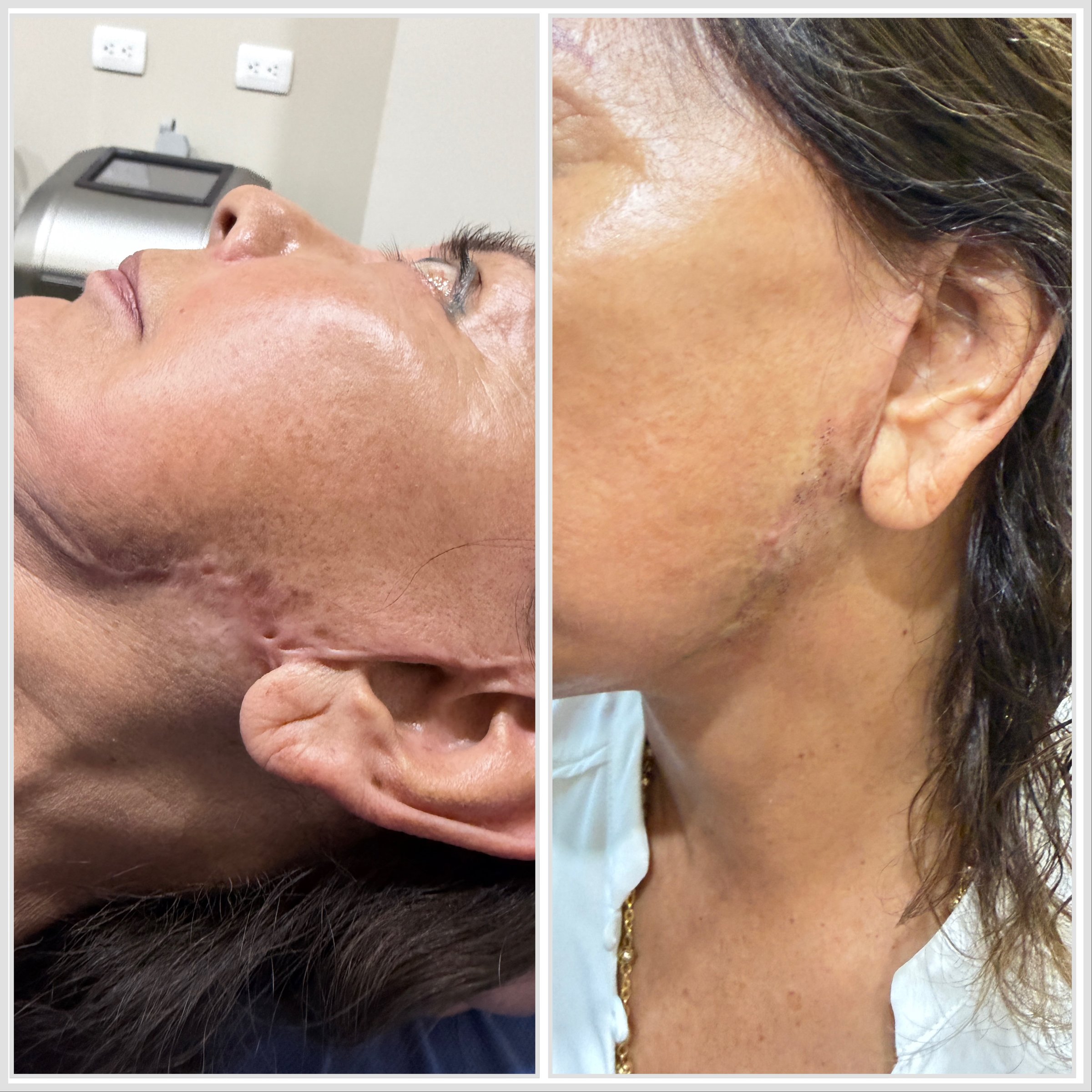 Antes y después de remoción de cicatriz con radiofrecuencia fraccionada