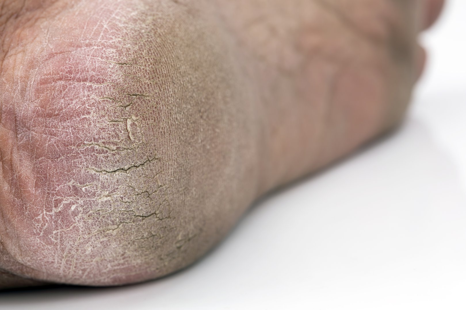 Cracked Heels: Close-up of a severely cracked heel, highlighting the dry, damaged skin and prompting the need for care and treatment.