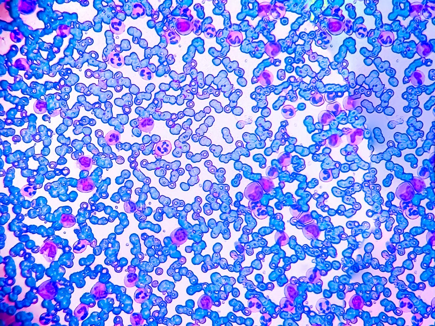 Microscopic finding, Neutrophilic leukocytosis, increase total count of White blood cell and increase number of neutrophils. Neutrophilic leukocytosis.