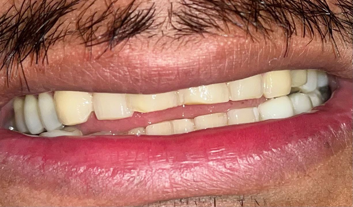 Antes de tratamiento con carillas - dientes pequeños