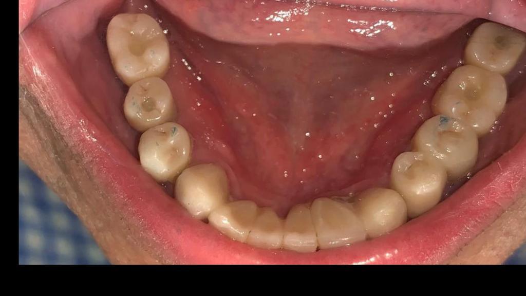 Fase 2: Preparación para implantes dentales