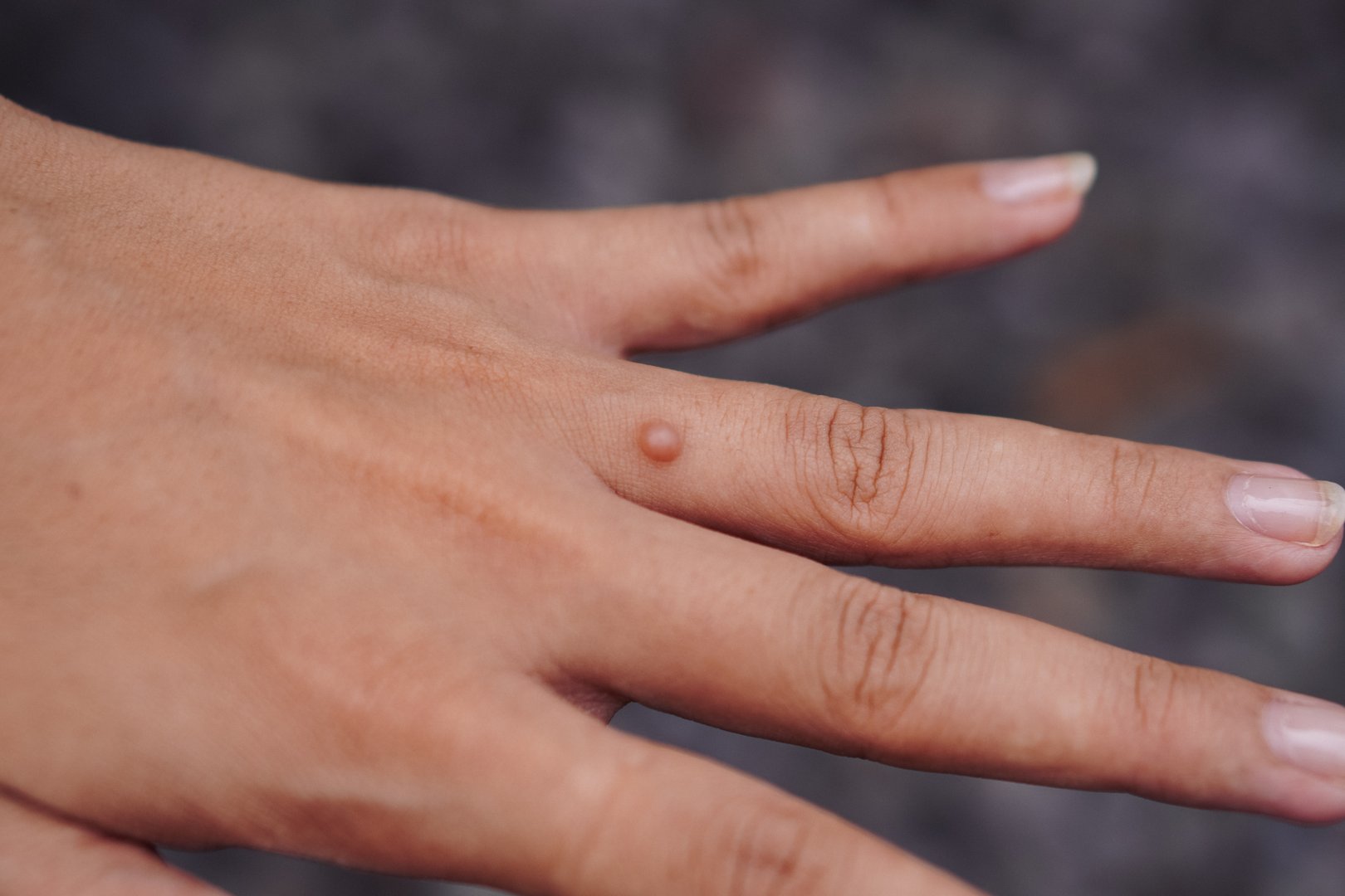 Finger wart on hand. Health concept. body wart