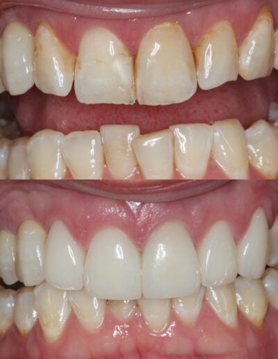 Patient before and after smile transformation with dental veneers