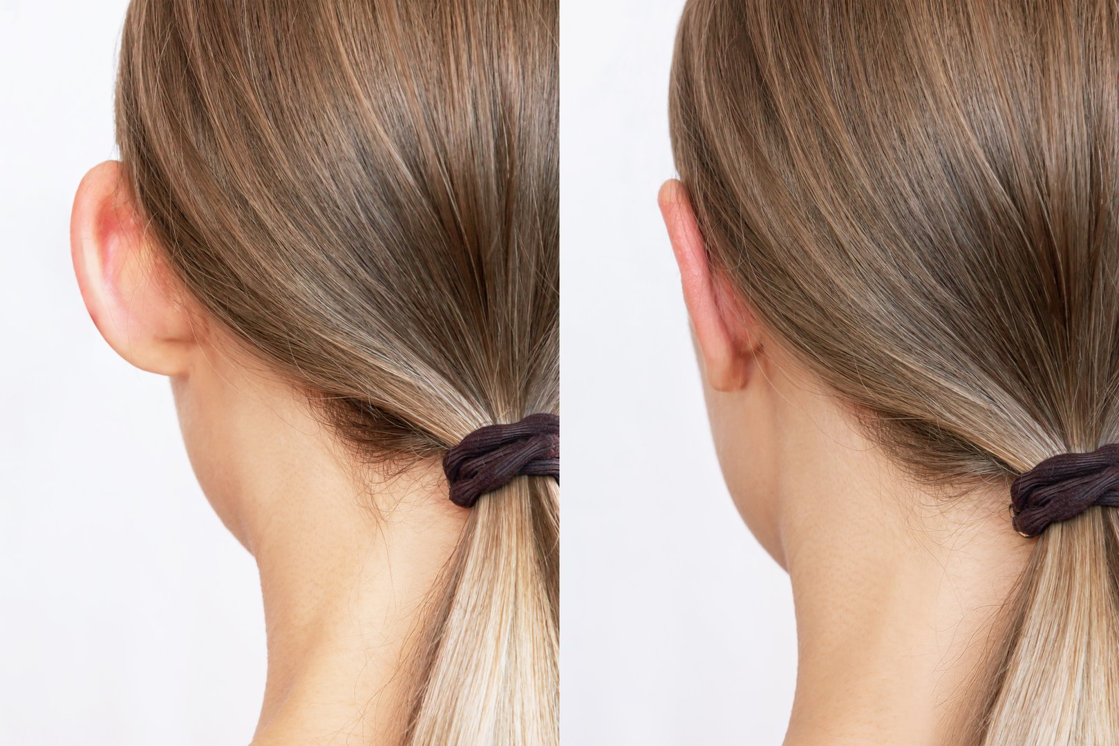 Cropped shot of woman's head with ears before and after otoplasty isolated on a white background. Result of cosmetic plastic surgery to correct the auricles and get rid of lop - eared. Beauty concept