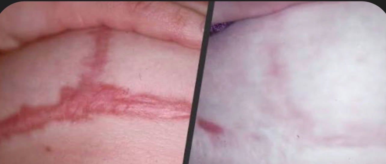 Before and after breast restoration scar camouflage result