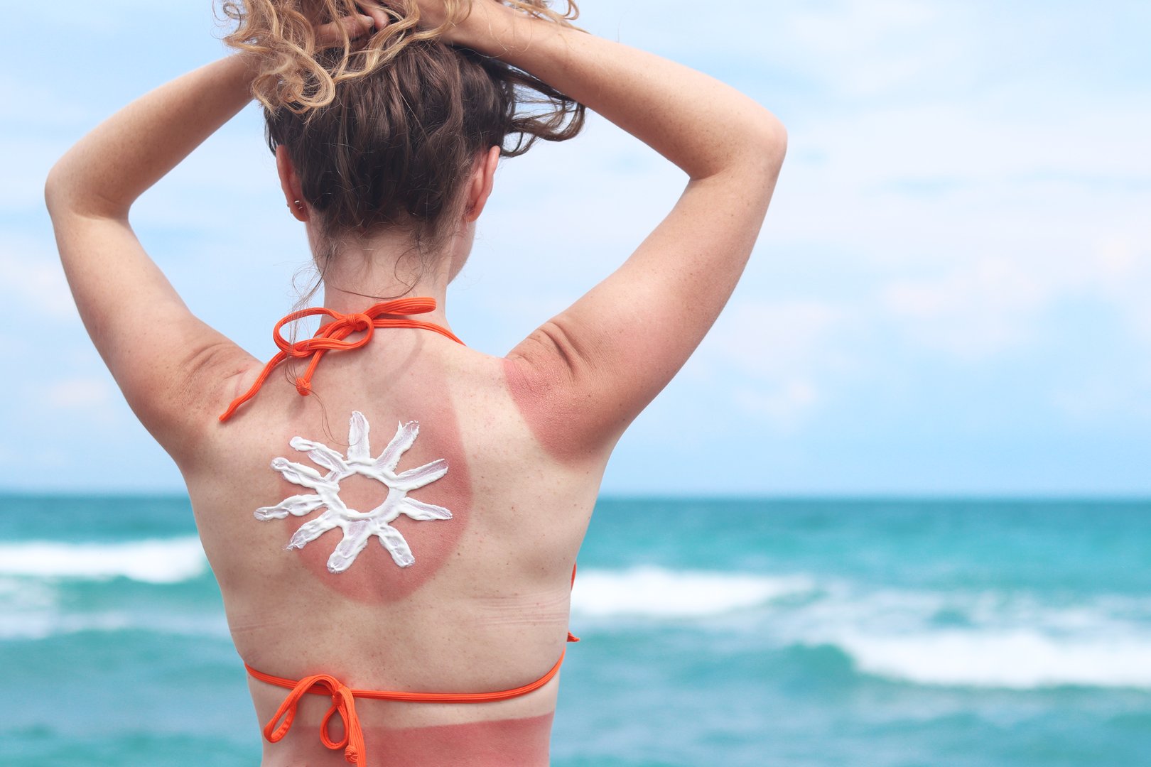 Sun drawing made with sunscreen on a woman's back. Redness of the skin from the sun after sunbathing on the beach. Close-up. Woman in a swimsuit, back view. Sun-damaged skin, the need to use sunscreen