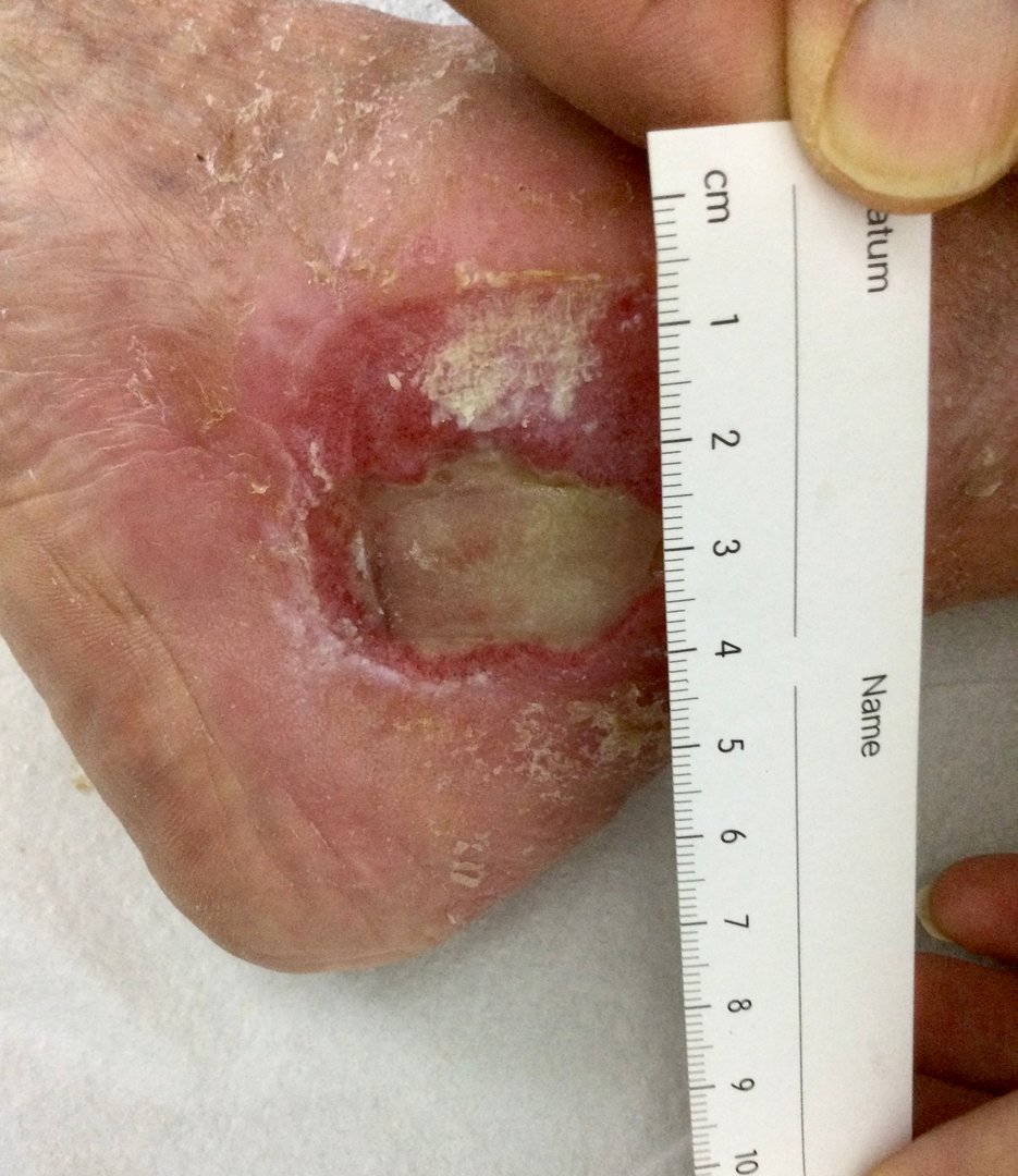 Fibrin covered leg ulcer