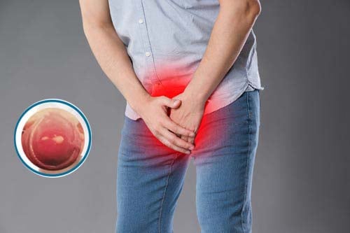 Hình ảnh minh họa lỗ sáo bị sưng đỏ ngứa