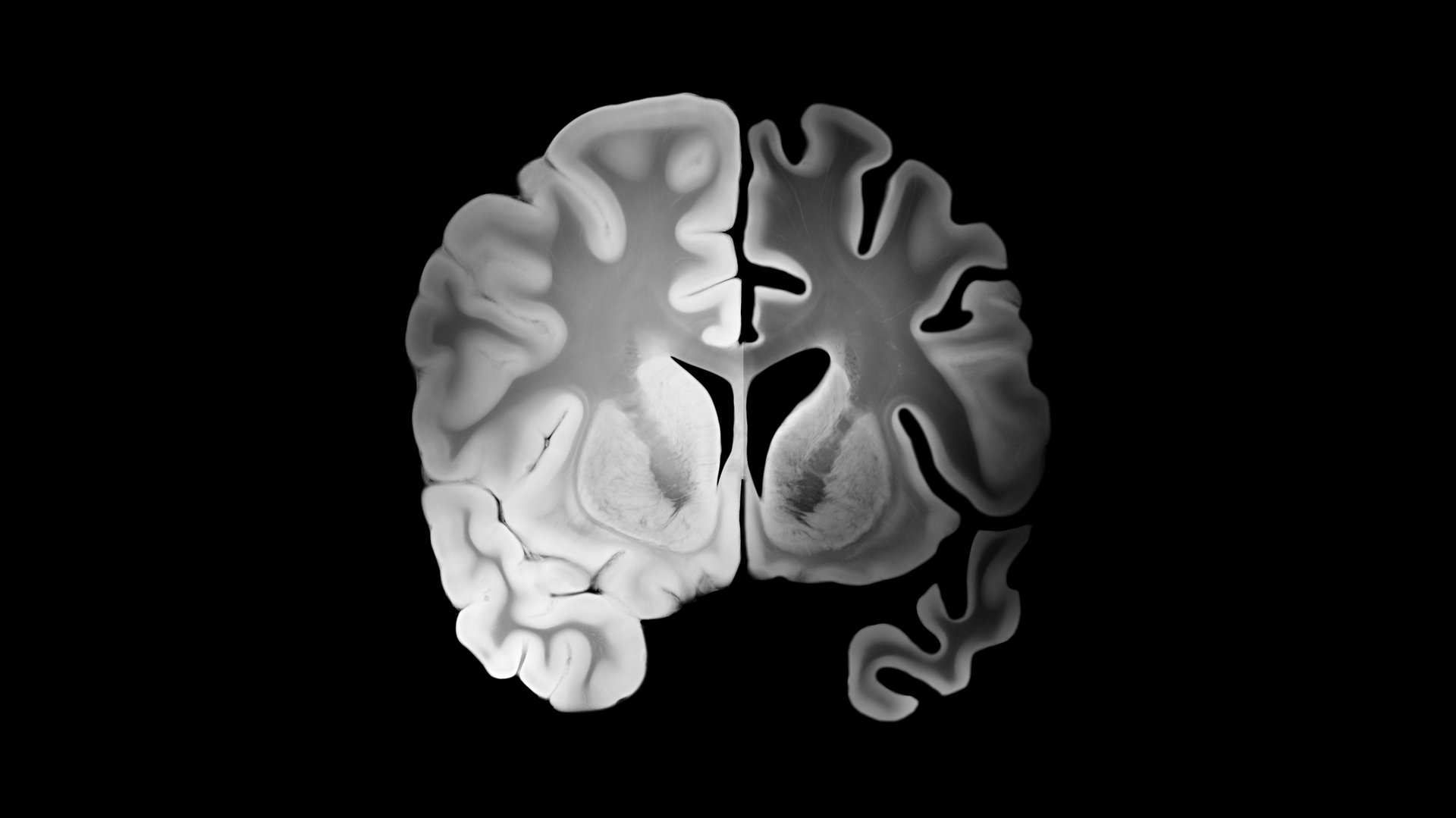 Alzheimer left hemisphere compared to healthy right hemisphere in a coronal brain slice with cortical thinning, widened sulci, enlarged ventricles and progressive brain tissue loss.