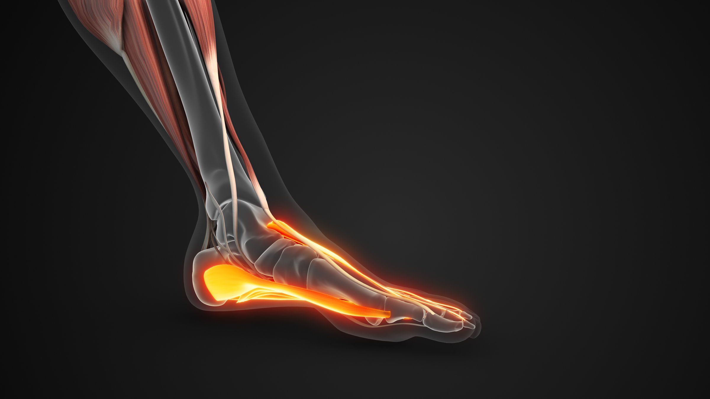 The plantar fascia is a band of tissue, called fascia, that connects your heel bone to the base of your toes. It supports the arch of the foot and absorbs shock when walking. Tension and stress on the fascia can cause small tears.
