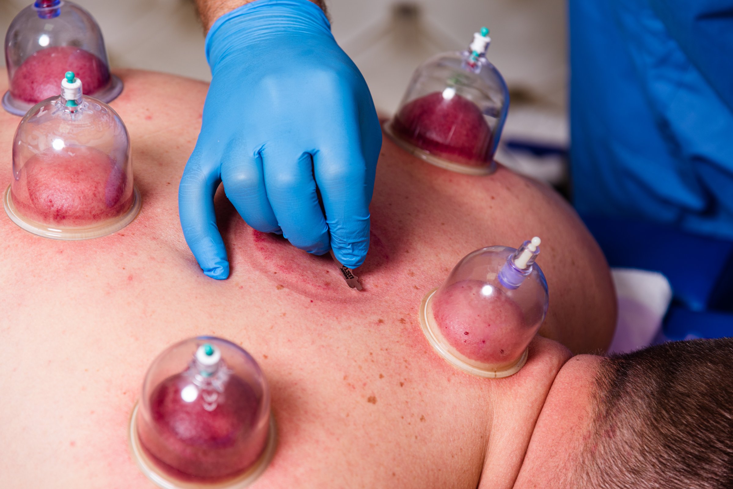 The doctor practices therapeutic massage, vacuum massage and hijama