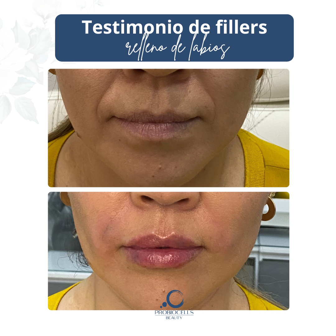 Testimonio de medicina estética - Resultado de tratamiento avanzado