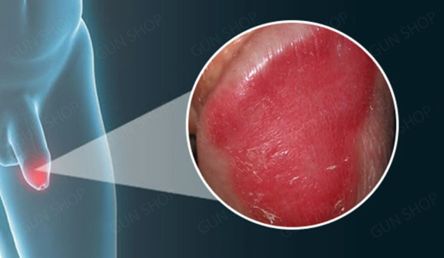 Hình ảnh minh họa bệnh dương vật